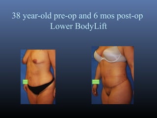 38 year-old pre-op and 6 mos post-op
Lower BodyLift

 