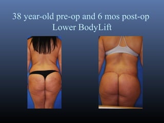 38 year-old pre-op and 6 mos post-op
Lower BodyLift

 