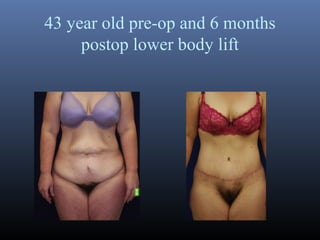 43 year old pre-op and 6 months
postop lower body lift

 