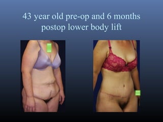 43 year old pre-op and 6 months
postop lower body lift

 
