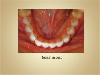 Incisal aspect
 