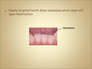 ■ Newly erupted teeth show mamelons which wear off
upon mastication
Mamelons
 