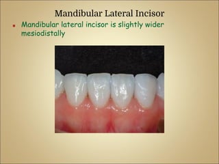Mandibular Lateral Incisor
■ Mandibular lateral incisor is slightly wider
mesiodistally
 