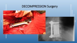 DECOMPRESSION Surgery
 