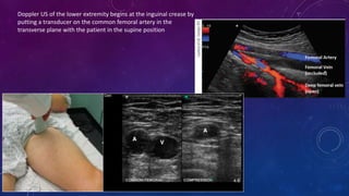 lower extremity  doppler ultrasound.pptx
