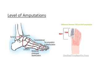Lower extremity prostheses | PDF