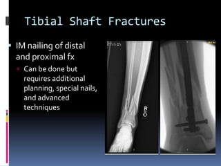  IM nailing of distal
and proximal fx
 Can be done but
requires additional
planning, special nails,
and advanced
techniques
Tibial Shaft Fractures
 