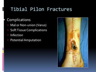 Tibial Pilon Fractures
 Complications
 Mal or Non-union (Varus)
 SoftTissue Complications
 Infection
 PotentialAmputation
 