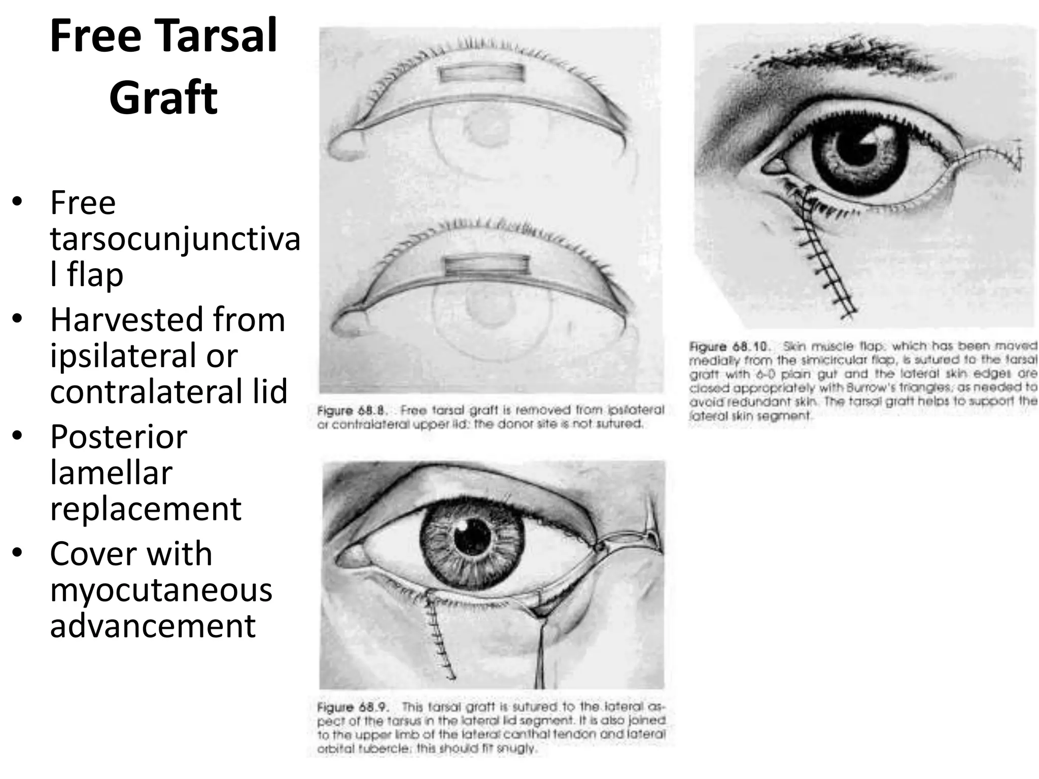 Lower eyelid reconstruction | PPTX