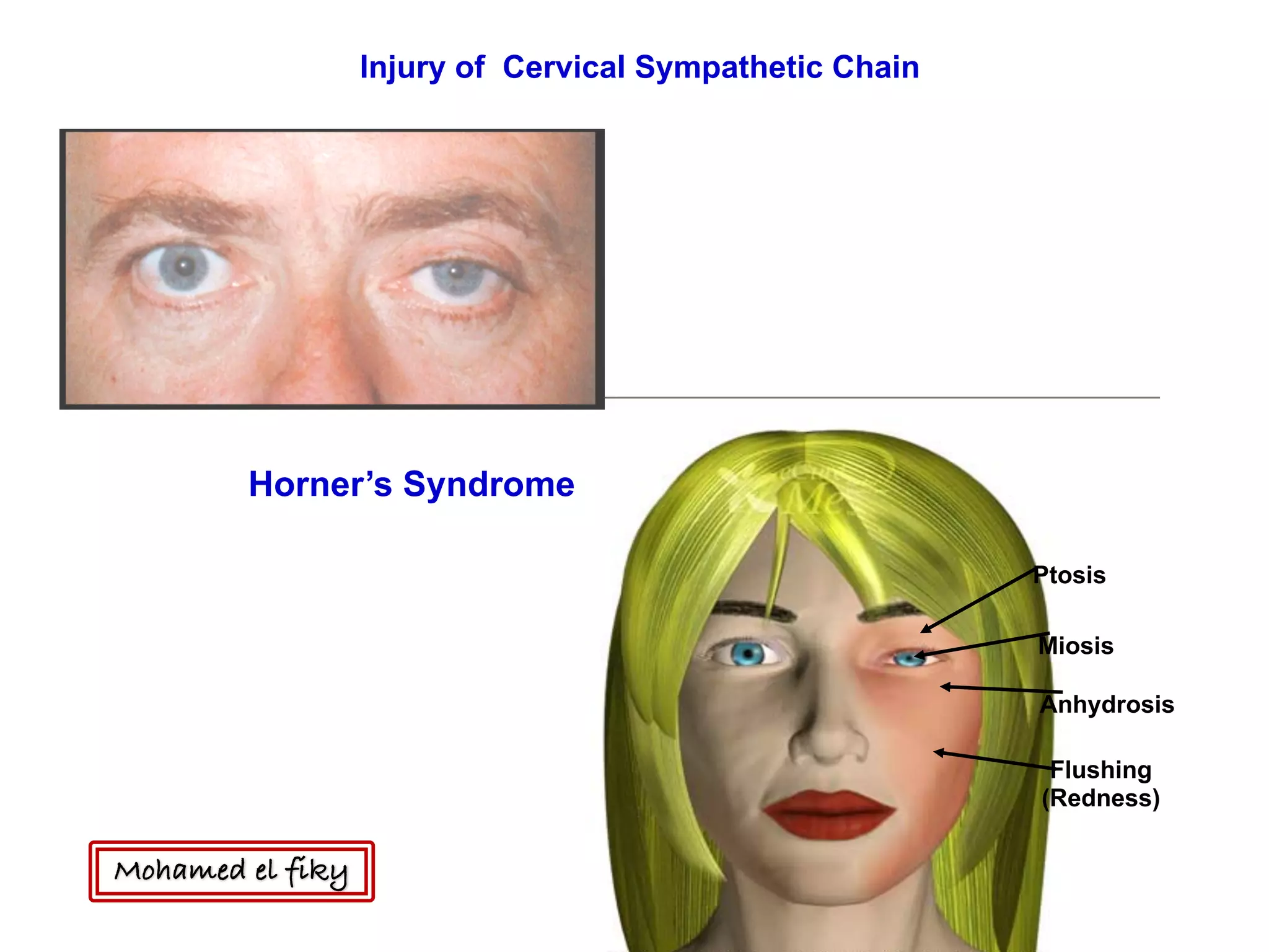 Horner’s Syndrome
Ptosis
Miosis
Anhydrosis
Flushing
(Redness)
Injury of Cervical Sympathetic Chain
Mohamed el fiky
 