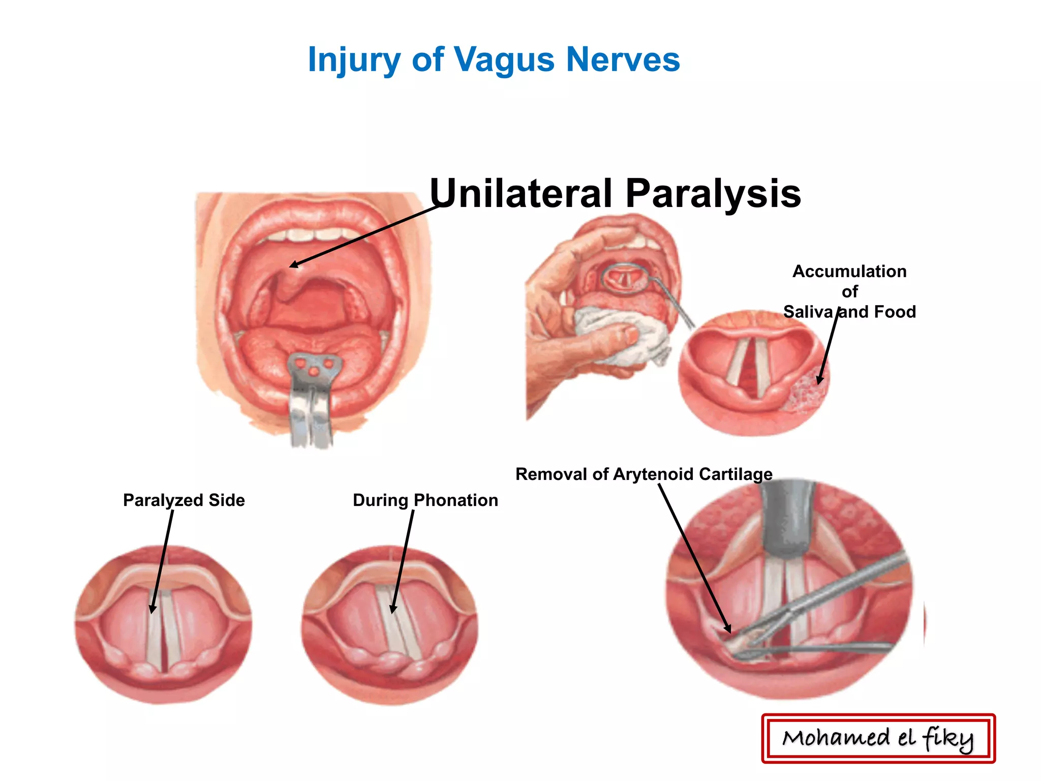 Unilateral Paralysis
Accumulation
of
Saliva and Food
Paralyzed Side During Phonation
Removal of Arytenoid Cartilage
Injury of Vagus Nerves
Mohamed el fiky
 