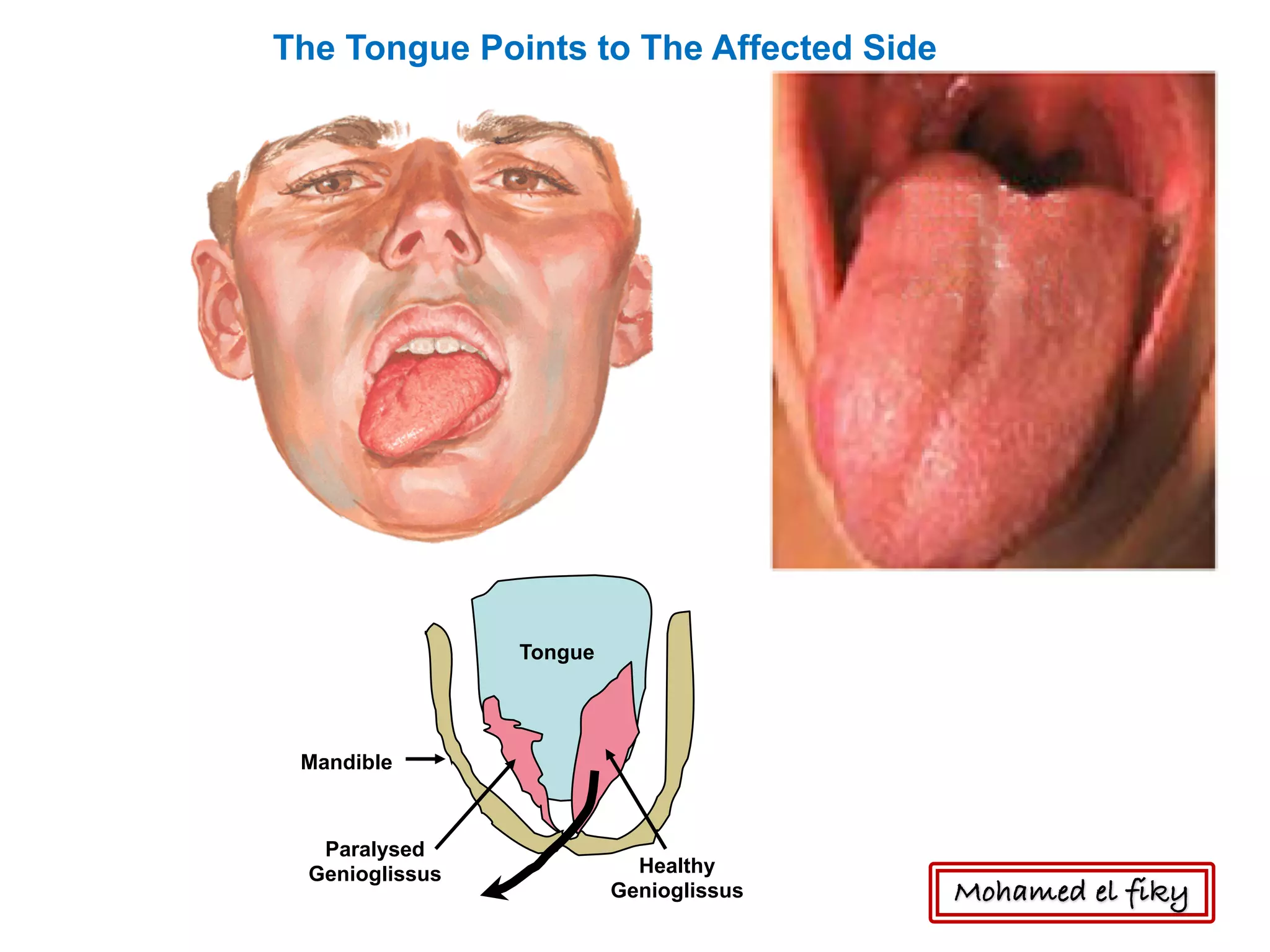 The Tongue Points to The Affected Side
Tongue
Healthy
Genioglissus
Mandible
Paralysed
Genioglissus
Mohamed el fiky
 