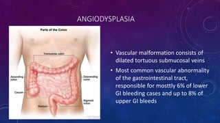 ANGIODYSPLASIA
• Vascular malformation consists of
dilated tortuous submucosal veins
• Most common vascular abnormality
of the gastrointestinal tract,
responsible for mosttly 6% of lower
GI bleeding cases and up to 8% of
upper GI bleeds
 