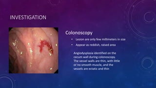 INVESTIGATION
Colonoscopy
• Lesion are only few millimeters in size
• Appear as reddish, raised area
Angiodysplasia identified on the
cecum wall during colonoscopy.
The vessel walls are thin, with little
or no smooth muscle, and the
vessels are ectatic and thin
 