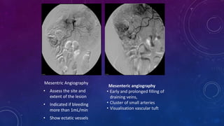 Mesentric Angiography
• Assess the site and
extent of the lesion
• Indicated if bleeding
more than 1mL/min
• Show ectatic vessels
Mesenteric angiography
• Early and prolonged filling of
draining veins,
• Cluster of small arteries
• Visualisation vascular tuft
 