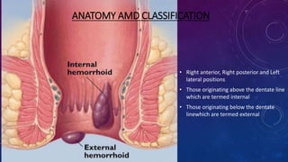• Right anterior, Right posterior and Left
lateral positions
• Those originating above the dentate line
which are termed internal
• Those originating below the dentate
linewhich are termed external
ANATOMY AMD CLASSIFICATION
 