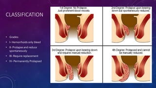 CLASSIFICATION
• Grades:
• I- Hemorrhoids only bleed
• II- Prolapse and reduce
spontaneously
• III- Require replacement
• IV- Permanently Prolapsed
 