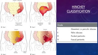 HINCHEY
CLASSIFICATION
 