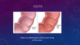 COLITIS
Refers to inflammation of the inner lining
of the colon
 