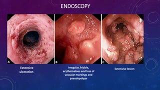 ENDOSCOPY
Extensive
ulceration
Irregular, friable,
erythematous and loss of
vascular markings and
pseudopolyps
Extensive lesion
 