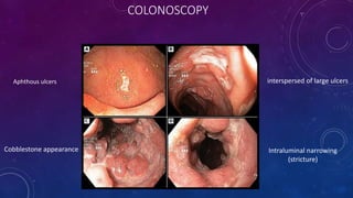 COLONOSCOPY
Aphthous ulcers interspersed of large ulcers
Cobblestone appearance Intraluminal narrowing
(stricture)
 
