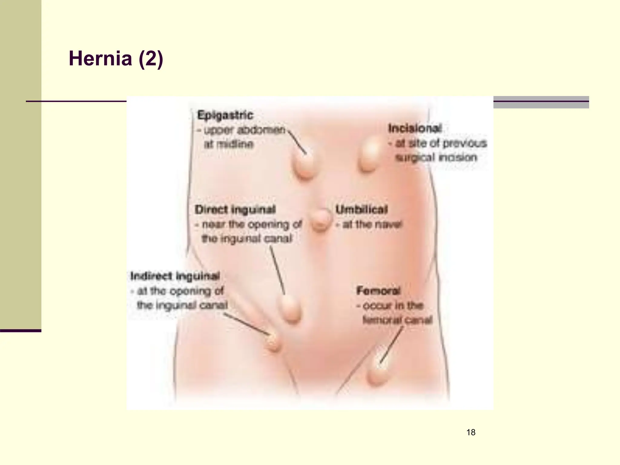 Hernia (2)
18
 