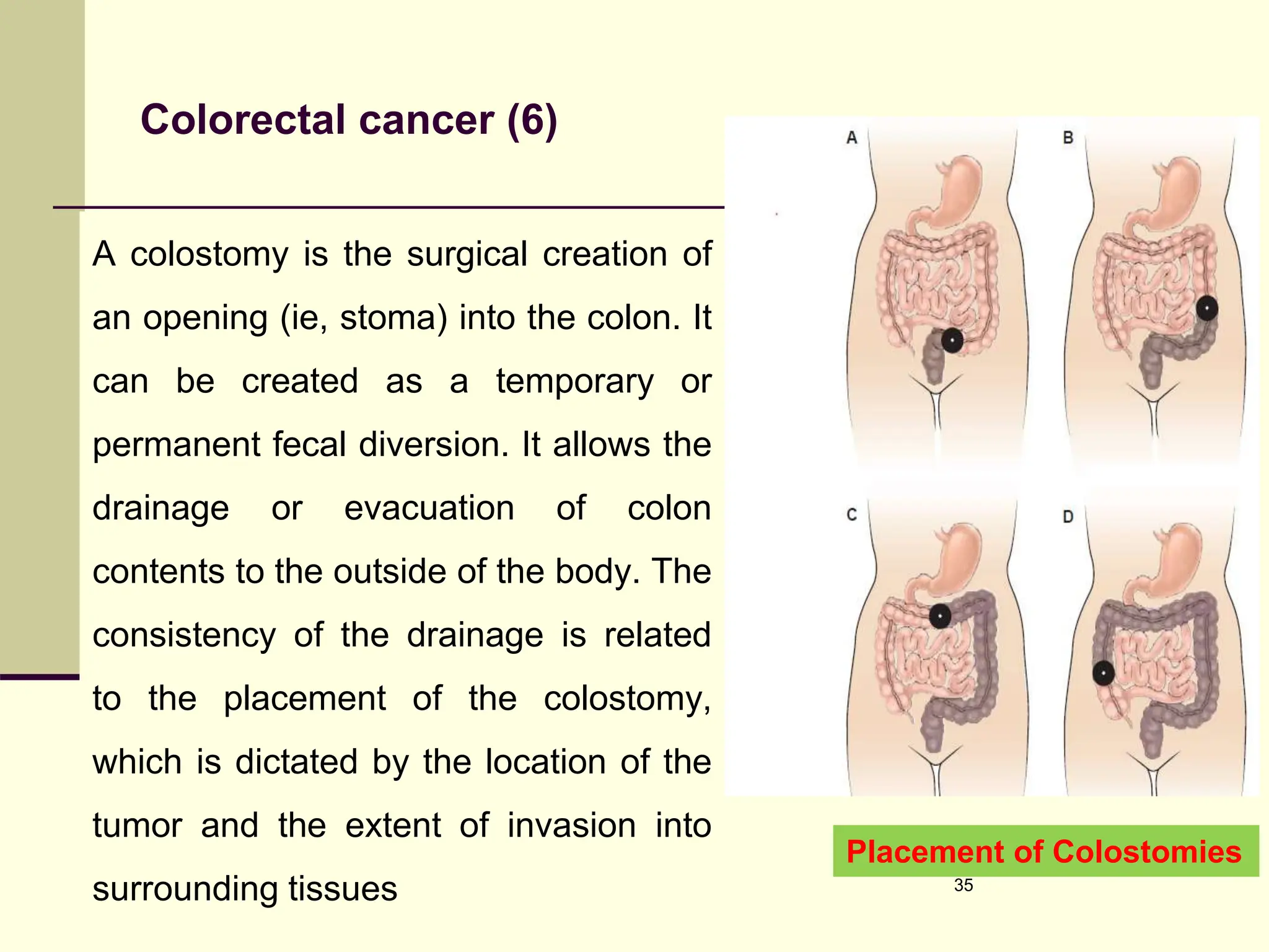 Colorectal cancer (6)
A colostomy is the surgical creation of
an opening (ie, stoma) into the colon. It
can be created as a temporary or
permanent fecal diversion. It allows the
drainage or evacuation of colon
contents to the outside of the body. The
consistency of the drainage is related
to the placement of the colostomy,
which is dictated by the location of the
tumor and the extent of invasion into
surrounding tissues 35
Placement of Colostomies
 