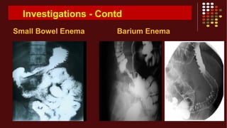 Investigations - Contd
Small Bowel Enema Barium Enema
 