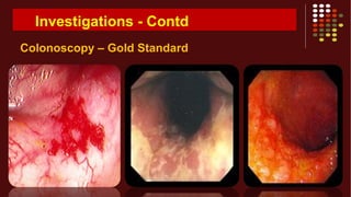 Investigations - Contd
Colonoscopy – Gold Standard
 