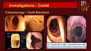 Investigations - Contd
Colonoscopy – Gold Standard
 