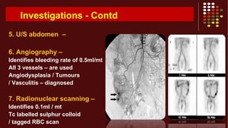 Investigations - Contd
5. U/S abdomen –
6. Angiography –
Identifies bleeding rate of 0.5ml/mt
All 3 vessels – are used
Angiodysplasia / Tumours
/ Vasculitis – diagnosed
7. Radionuclear scanning –
Identifies 0.1ml / mt
Tc labelled sulphur colloid
/ tagged RBC scan
 