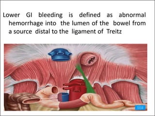 Lower GI bleeding is defined as abnormal
hemorrhage into the lumen of the bowel from
a source distal to the ligament of Treitz
 