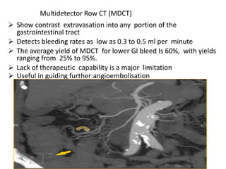Multidetector Row CT (MDCT)
 Show contrast extravasation into any portion of the
gastrointestinal tract
 Detects bleeding rates as low as 0.3 to 0.5 ml per minute
 The average yield of MDCT for lower GI bleed Is 60%, with yields
ranging from 25% to 95%.
 Lack of therapeutic capability is a major limitation
 Useful in guiding further:angioembolisation
 