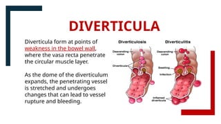 Diverticula form at points of
weakness in the bowel wall,
where the vasa recta penetrate
the circular muscle layer.
As the dome of the diverticulum
expands, the penetrating vessel
is stretched and undergoes
changes that can lead to vessel
rupture and bleeding.
DIVERTICULA
 