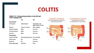 COLITIS
 