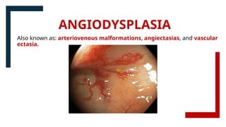 ANGIODYSPLASIA
Also known as: arteriovenous malformations, angiectasias, and vascular
ectasia.
 