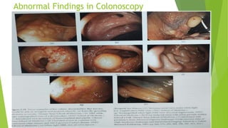 Abnormal Findings in Colonoscopy
 