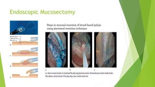 Endoscopic Mucosectomy
 