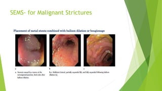 SEMS- for Malignant Strictures
 