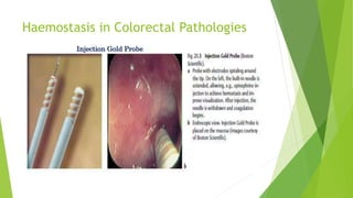 Haemostasis in Colorectal Pathologies
 