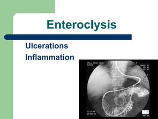 Enteroclysis
Ulcerations
Inflammation
 