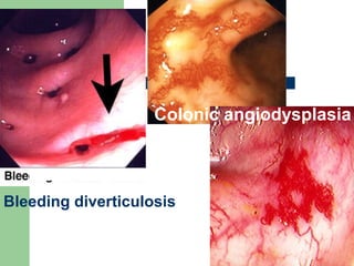 Bleeding diverticulosis
Colonic angiodysplasia
 