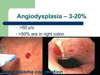 Angiodysplasia – 3-20%
– >50 y/o
–>50% are in right colon
argon plasma coagulation
 