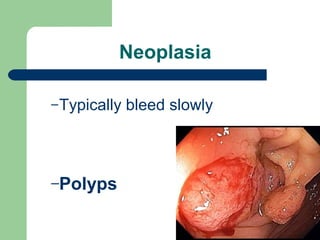 Neoplasia
–Typically bleed slowly
–Polyps
 