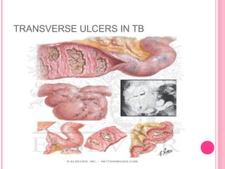 TRANSVERSE ULCERS IN TB
 