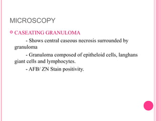 MICROSCOPY
 CASEATING GRANULOMA
- Shows central caseous necrosis surrounded by
granuloma
- Granuloma composed of epithelo...