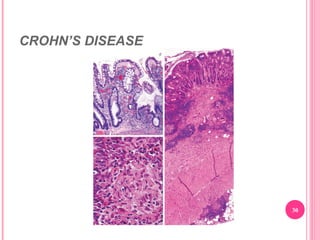 CROHN’S DISEASE
30
 