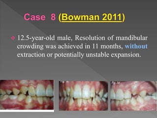 Lower insicors crowding in mixed dentition | PPT