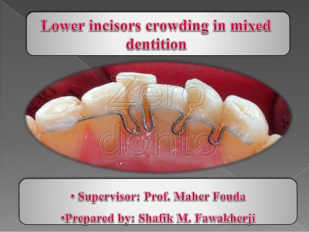 Lower Insicors Crowding In Mixed Dentition