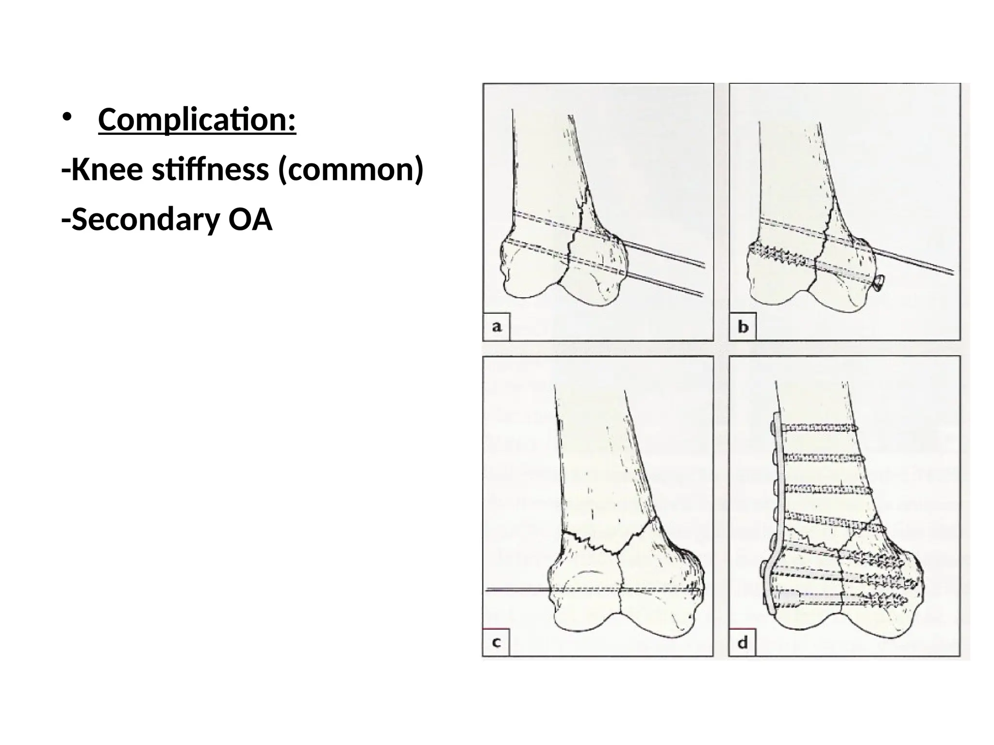 • Complication:
-Knee stiffness (common)
-Secondary OA
 